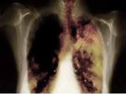 cara menyembuhkan kanker paru paru